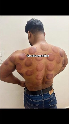 Cupping Therapy | Cups On, Pain Gone | Twelve meridian