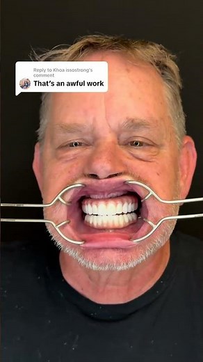 Why This Dental Implant Looks Like This (Explained) 🦷 #dentalimplants
