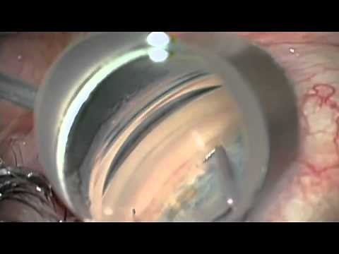 Combined Cataract Procedure with iStent Glaucoma Implant