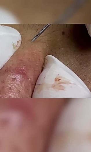 #acneskin #acne #spa