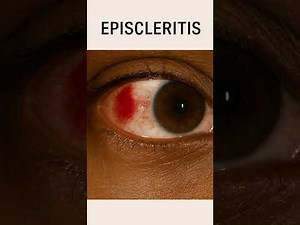 Red Eye Explained: How to Tell Conjunctivitis, Uveitis, or Scleritis Apart | Eye Learn Academy