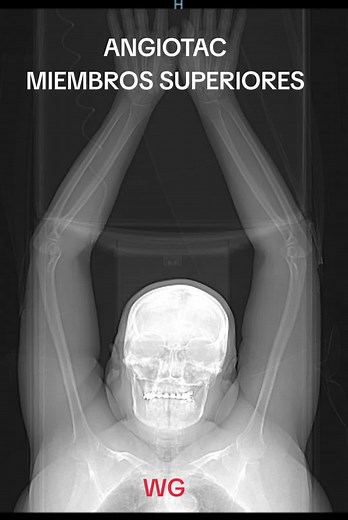 Angiotac Miembros Superiores: Visualizando Venas y Arterias