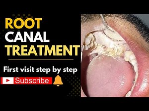 Root Canal Treatment [RCT] Step-by-Step Procedure, Pain-Free & Safe Dental Care#satisfying #dentist