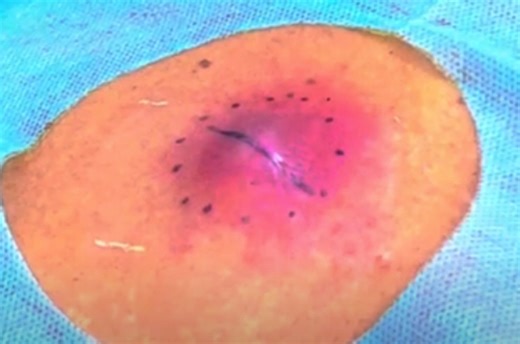Infected Sebaceous Cyst on Back Incision and Drainage