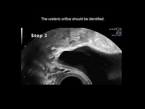 UOG video clip: how to assess the ureters during pelvic ultrasound