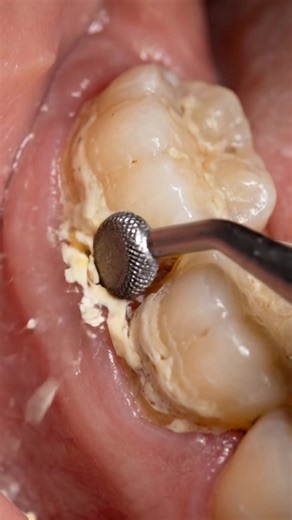 Understanding the Importance of Plaque Removal