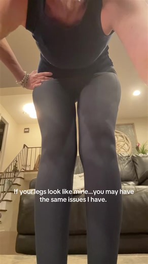 Understanding Lipedema Symptoms and Management Tips