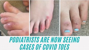 COVID Toes