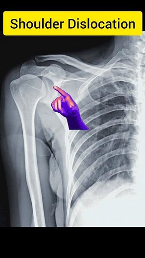 Shoulder Dislocation