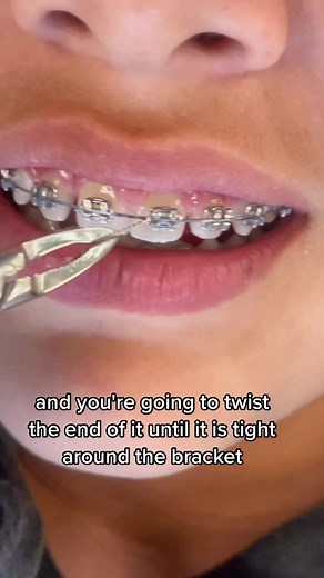 BracesByGrant on TikTok