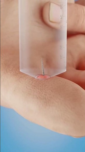 ​The Easiest Way to Remove a Splinter! 💉✨ (No Tweezers Needed)
