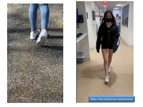 Dr. Rozbruch discusses treatment of excessive femoral anteversion or in-toeing gait