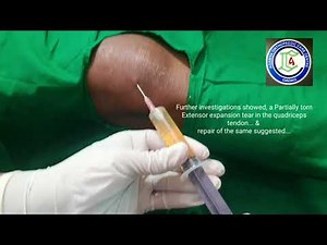 Pre-patellar Bursitis | Bursa Aspiration | Knee Aspiration | Adamya Hospital Videos