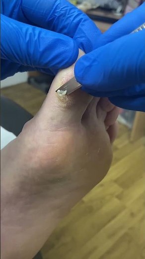 Ultimate Big Toe Callus Transformation by Australian Podiatrist #FootCare #PodiatryTips