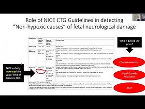 Quo Vadis Fetal Heart Rate Monitoring? NICE CTG Guideline vs Physiological CTG Interpretation