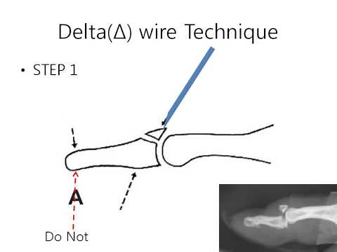 [Delta wire Technique] Bony Mallet Finger
