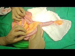 Meckel diverticulum surgery how i do it
