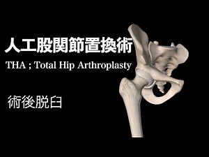 【医学】人工股関節置換術・術後脱臼