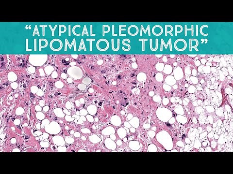 "Atypical pleomorphic lipomatous tumor" (mimic of liposarcoma) (AIP France 2021 - case 13)