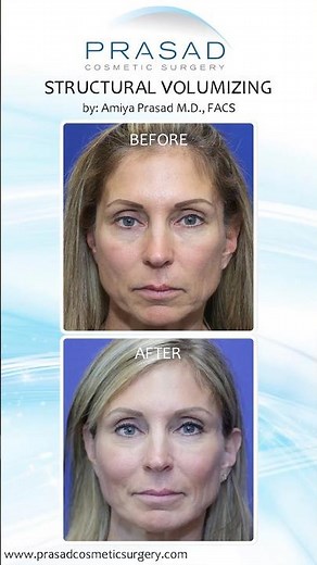 Facial Rejuvenation: Why Volume is as Important as Skin #facial