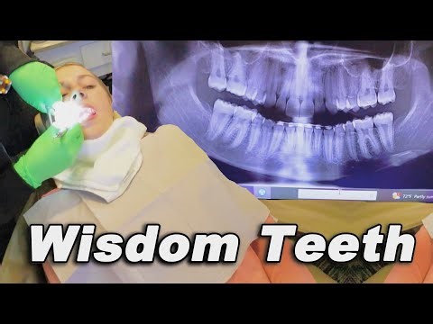 NO Wisdom Teeth!