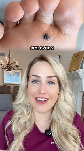 Is THIS the best treatment for warts?!