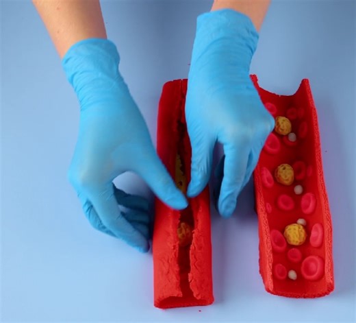 24K views · 28 reactions | Artery stenting procedure explained | 5-Minute Crafts SHORTS | Facebook