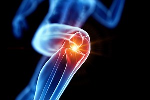 Gonarthrosis or arthrosis of the knee: symptoms and diagnosis