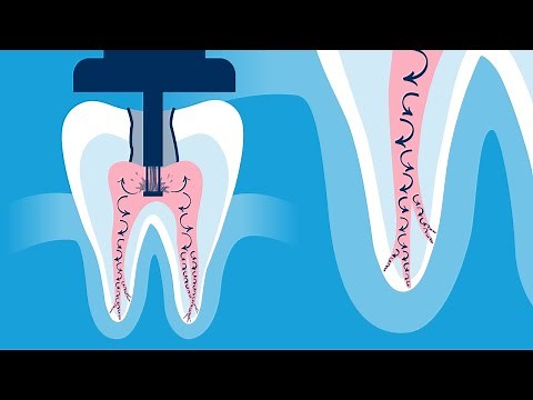 Discover the Innovative GentleWave® Procedure