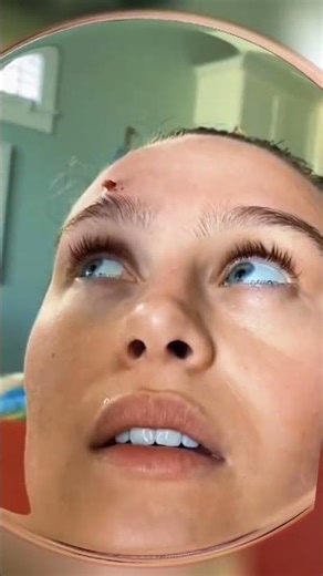 Popping a Forehead Pimple in the Mirror — POV! 👀