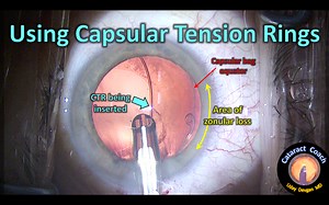 Capsular Tension Rings in Cataract Surgery