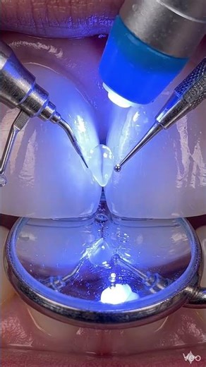 The Art of Dental Bonding: A Step-by-Step Visualization