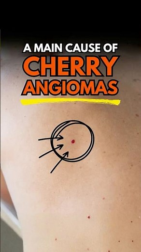 A Main Cause of Cherry Angiomas