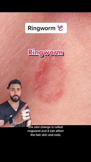 Have you heard of ringworm before? 🪱 #medtiktok #medicineexplained #learnontiktok