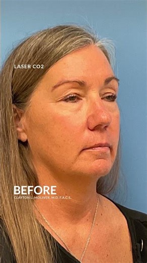 CO Laser Skin Resurfacing Before and After #co2lasertreatment #skinresurfacing #antiageingskincare