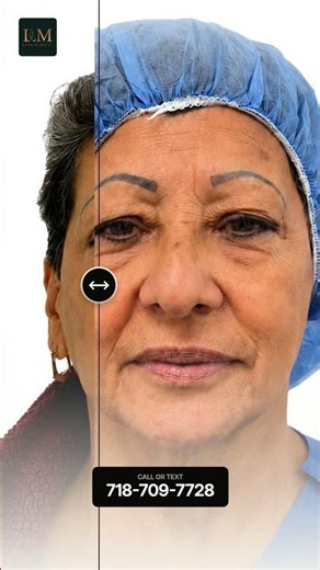 Upper and lower blepharoplasty
