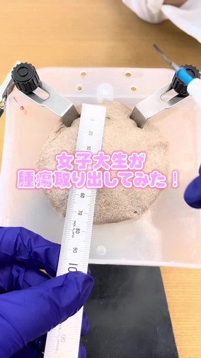 一般文系女子大生が腫瘍取り出してみた⁉️ 2回目の挑戦♪