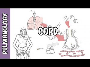 Chronic Obstructive Pulmonary Disease (COPD): Causes, Pathophysiology, and Treatment • Video • MEDtube.net