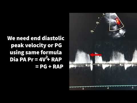 How to estimate pulmonary artery pressure on Echo