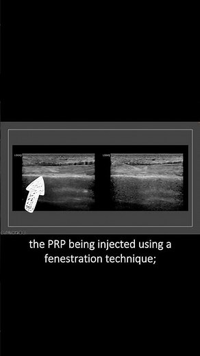#ultrasound Guided Interventions: Cases (ECU Tendon PRP Injection)