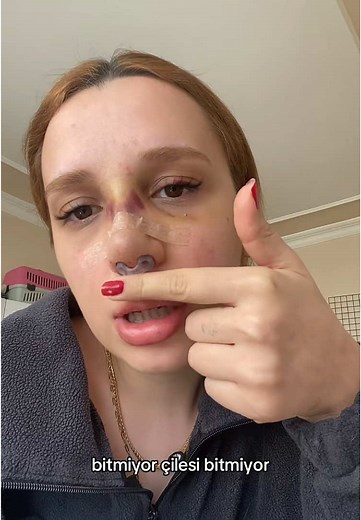 HELPPPP🥲 #fypシ゚ #burunameliayatısürecim #estetik #rinoplastia