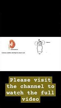 Hydronephrosis - Anatomy, Causes, Pathophysiology, Complications, Diagnosis, And Treatment