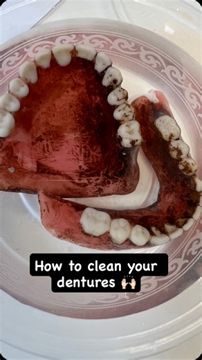 Dr.mariam on Instagram: "🦷 How to Clean Complete Dentures – Full Guide 📌 Why Cleaning Dentures Matters • Prevents bad breath • Reduces fungal infection (Candida) • Avoids staining & plaque • Improves oral hygiene & longevity of denture ✨Daily Cleaning Routine (Step-by-Step) 🪥 Step 1: Rinse After Meals • Remove denture after eating. • Rinse under running water. • Removes food particles. 🧴 Step 2: Brush the Denture Use a denture brush or soft-bristle toothbrush and: • Non-abrasive denture clea