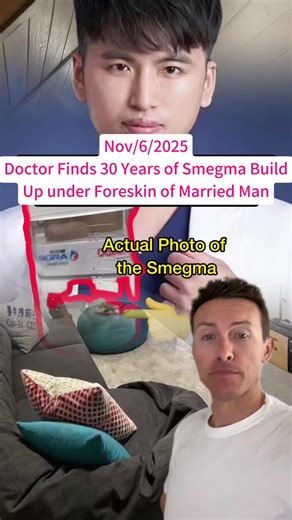Urologist removes shocking 30-year smegma buildup in married man—Urgent PSA for foreskin care! 🚿 #health #urology #fyp #viral #menshealth #cleaningtips #storytime #pov