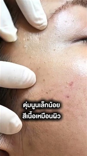 Mole vs. Skin Tag Characteristics #co2laser #skincare #mole removal #mole cauterization #skin tag...