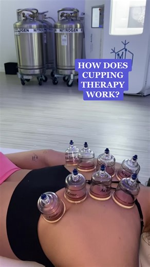 Cupping uses a suction method to pull the muscle and promote healing by bringing blood to the area. The red marks last anywhere from a few hours to several days. The darker the marks, the more stagnant fluids (toxins, blood and lymph) were released during treatment. The more often you receive cupping for the same issue, the lighter the marks will be! #tryit #cuppingtherapy #cupping #musclerecovery #musclehealth #blood #cuppingmarks #releasetoxins