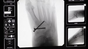 Percutaneous Stabilization of a Fracture Dislocation