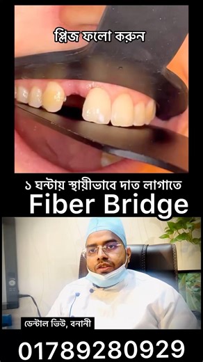 Get permanent teeth in just 1 hour. Fiber Bridge. #clinicaldentistry #fixedtooth