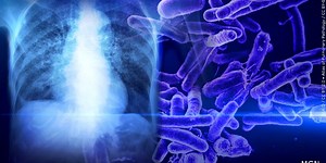 Douglas County officially declares public health emergency after tuberculosis exposures