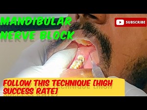Guaranteed Success: The Art of the Mandibular Nerve Block (IAN Block) #youtubevideo#viralvideo